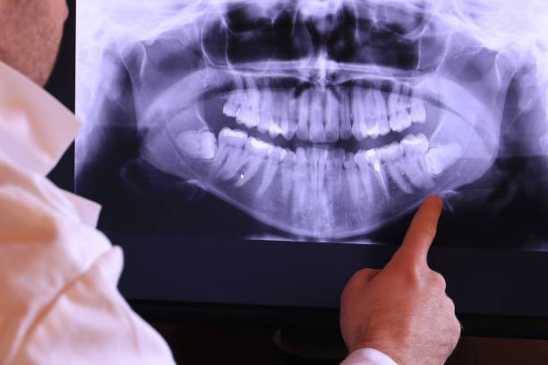Best Emergency Dentist for Lost Fillings or Crowns in Vero Beach, FL